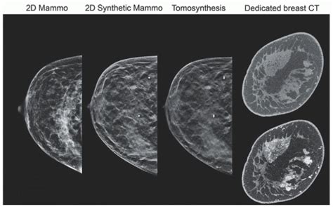 Mammography and Breast Imaging .
